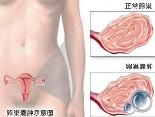 运城卵巢囊肿的危害有哪些