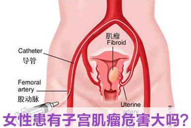 运城子宫肌瘤的危害有哪些