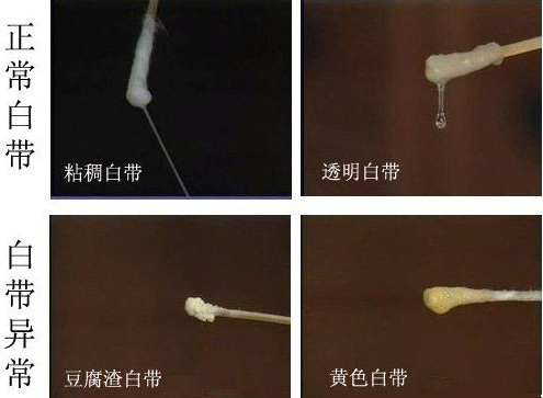 运城引起白带发黄的原因有哪些